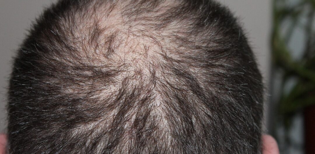 Keep Your Hair On: 7 Ways To Deal With Hair Loss 4 Keep Your Hair On 7 Ways To Deal With Hair Loss - Balding Man